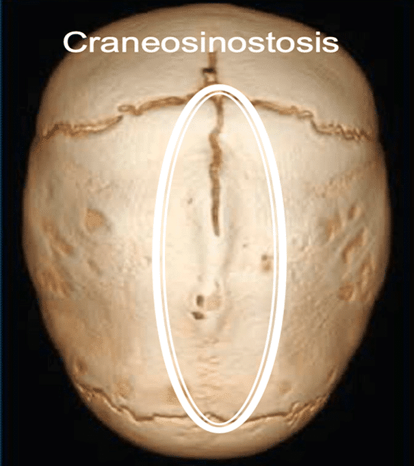 imagen de craneo con craneosinostosis