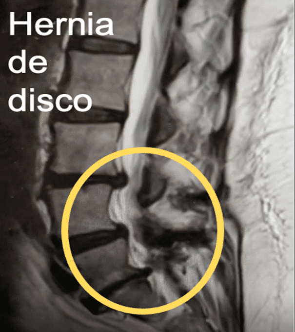 Resonancia de hernia de disco
