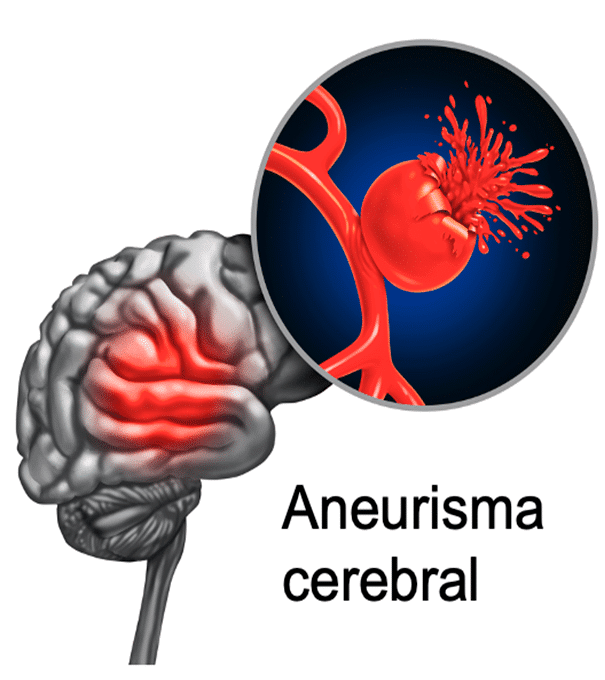 imagen ilustrativa de aneurisma cerebral