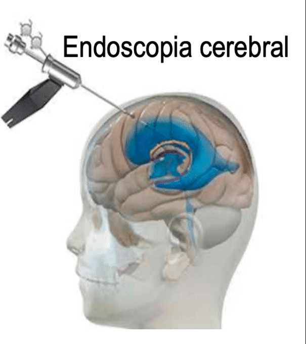 imagen ilustrativa de endoscopia cerebral