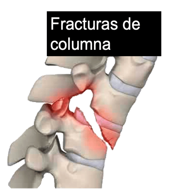 imagen ilustrativa de fractura de columna