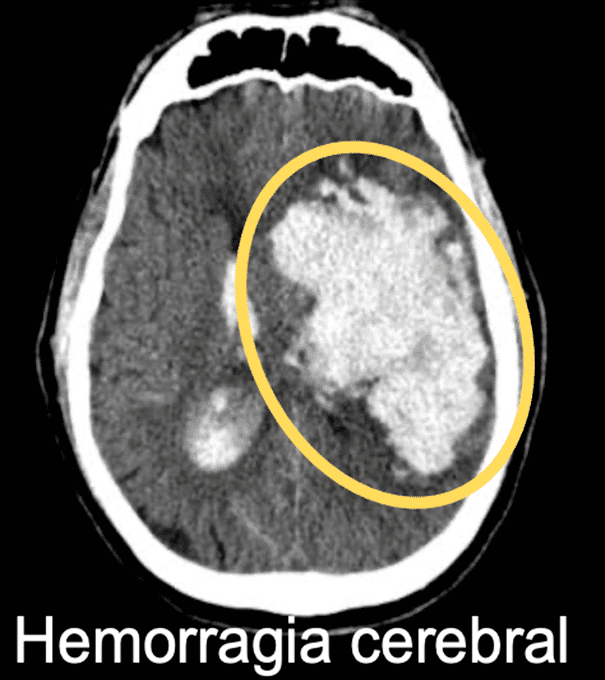 tomografia de hemorragía cerebral