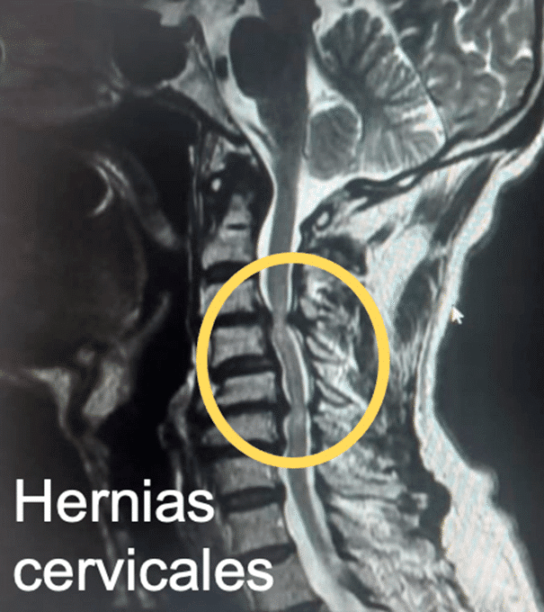 resonancia magnetica de hernias cervicales