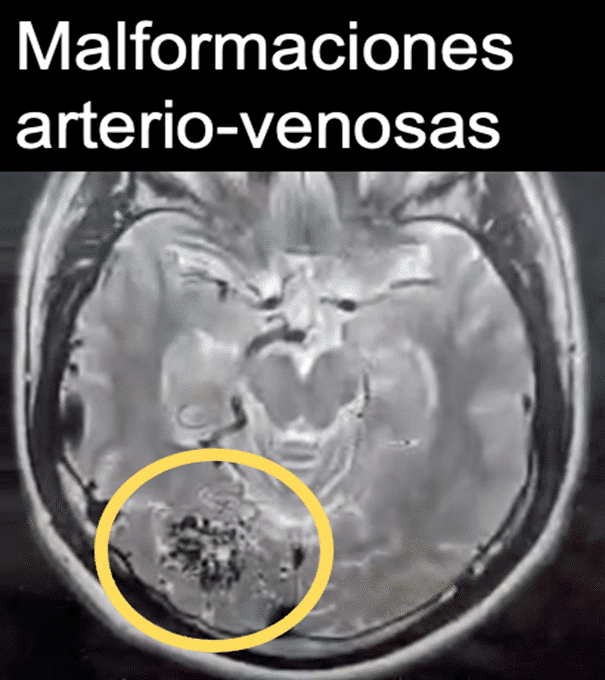 resnonancia magnética de malformaciones arterio venosas