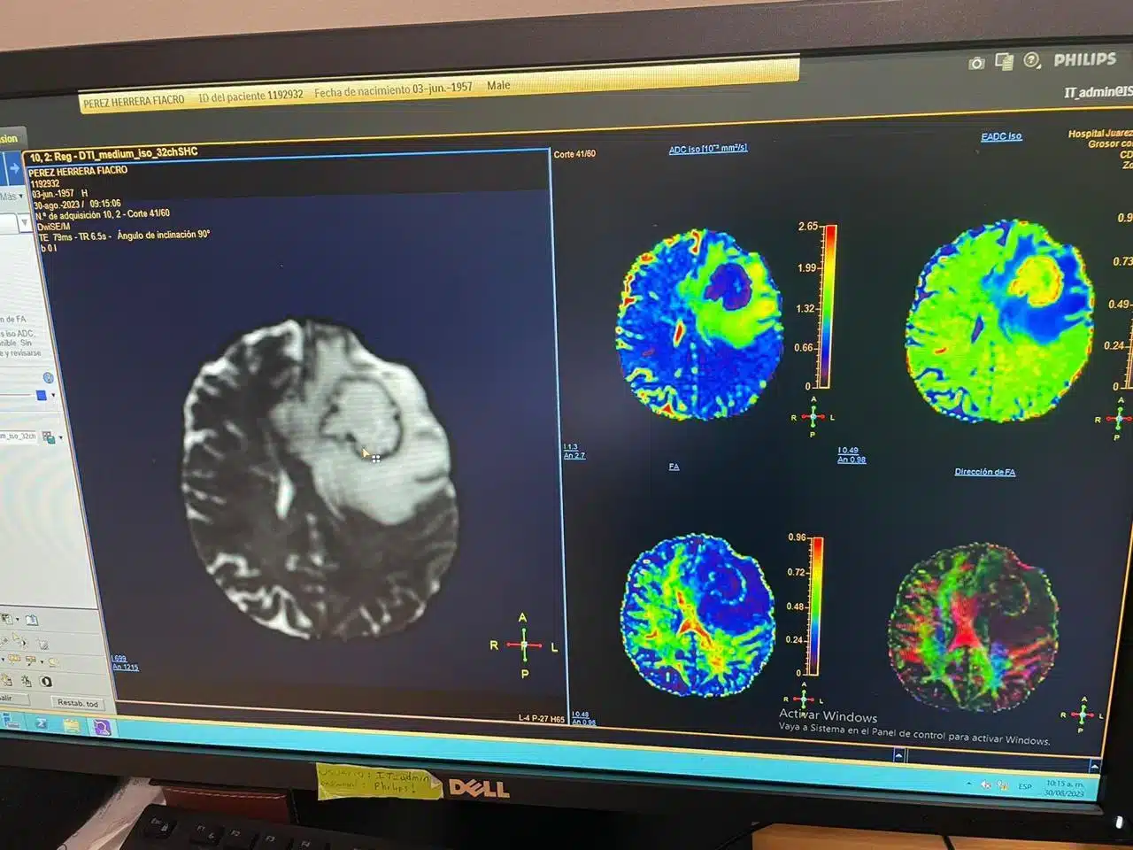 fotografia de una pantalla con una resonancia mágnetica cerebral
