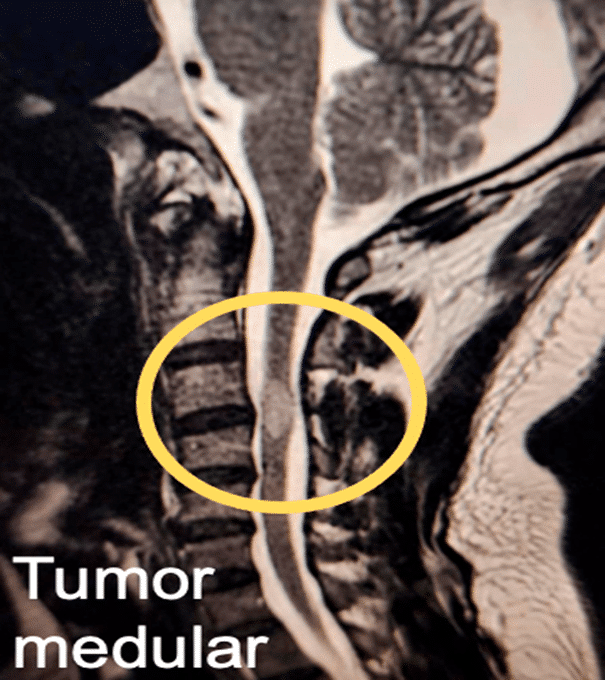 resonancia magentica de tumor medular tratamiento neurológico